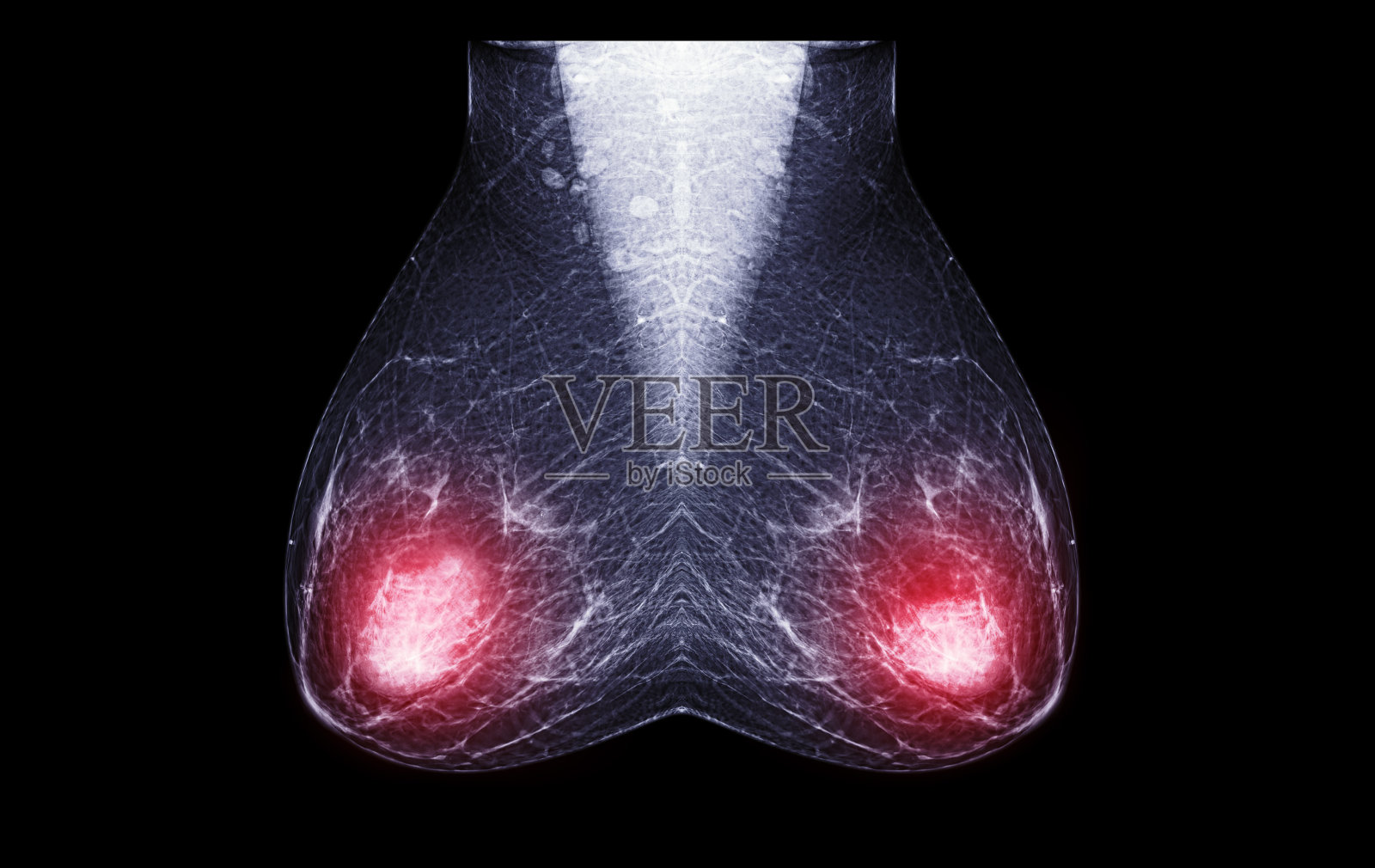 x射线数字乳房x线照片或乳房x线照片是x +乳房图像的妇女检查乳腺癌。照片摄影图片