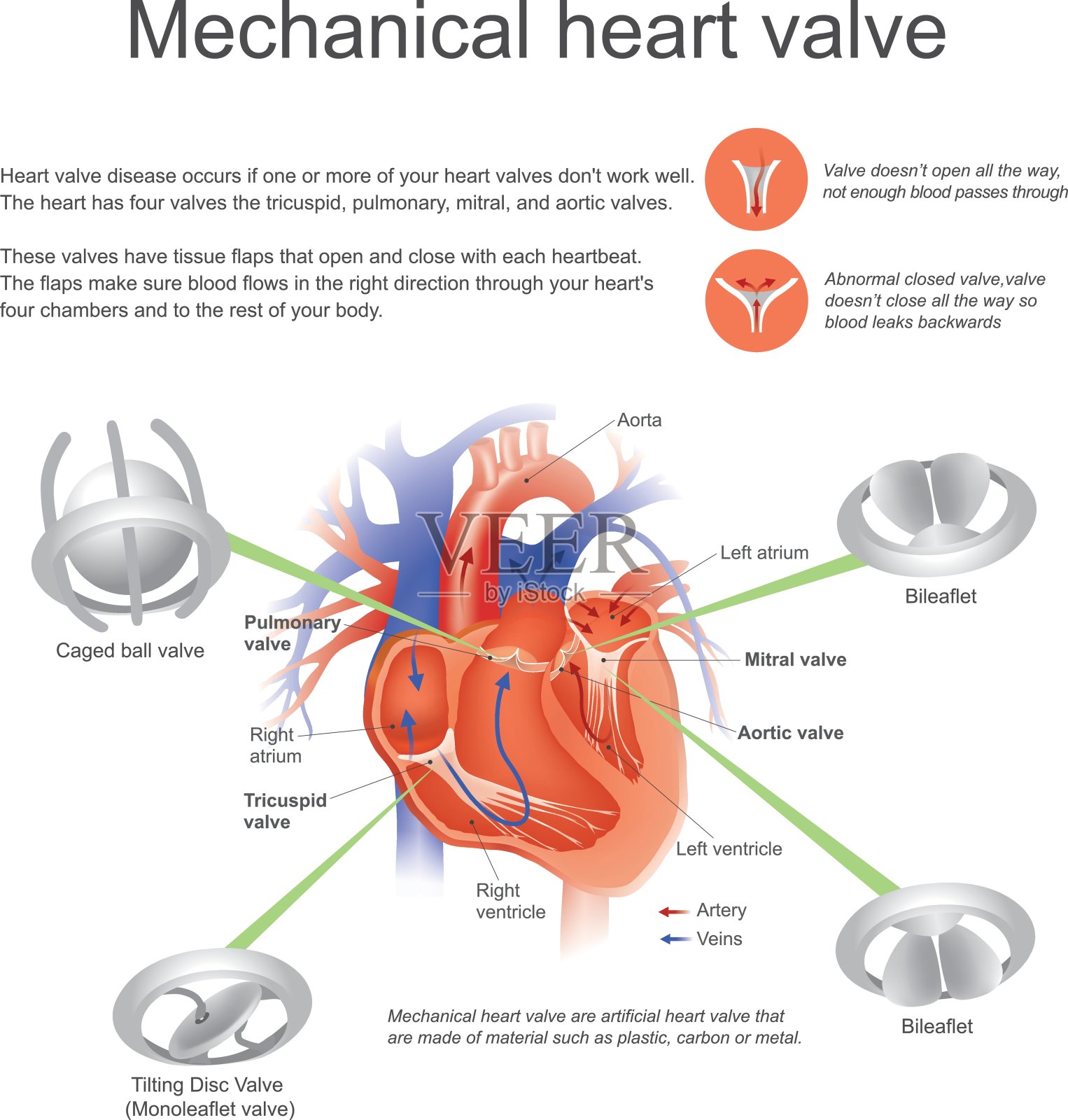 心脏换瓣手术：生物瓣or机械瓣如何选？_医学界-助力医生临床决策和职业成长
