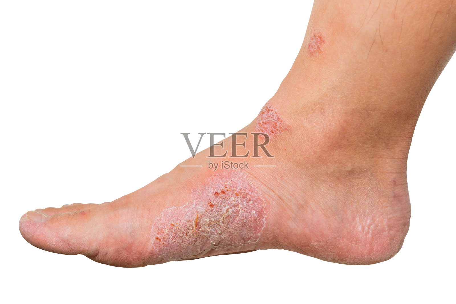 人脚上的伤口和干燥皮肤。溃疡和感染的医学概念。照片摄影图片