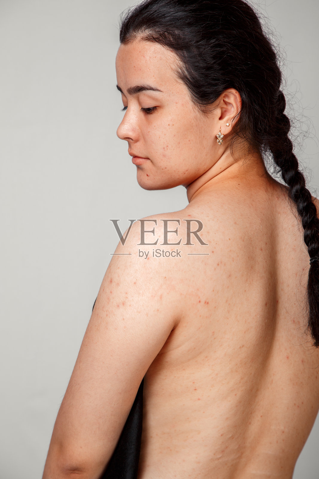 一个年轻女孩脸上和身上的痤疮和丘疹。一个孤立的背景。医学和美容的概念照片摄影图片
