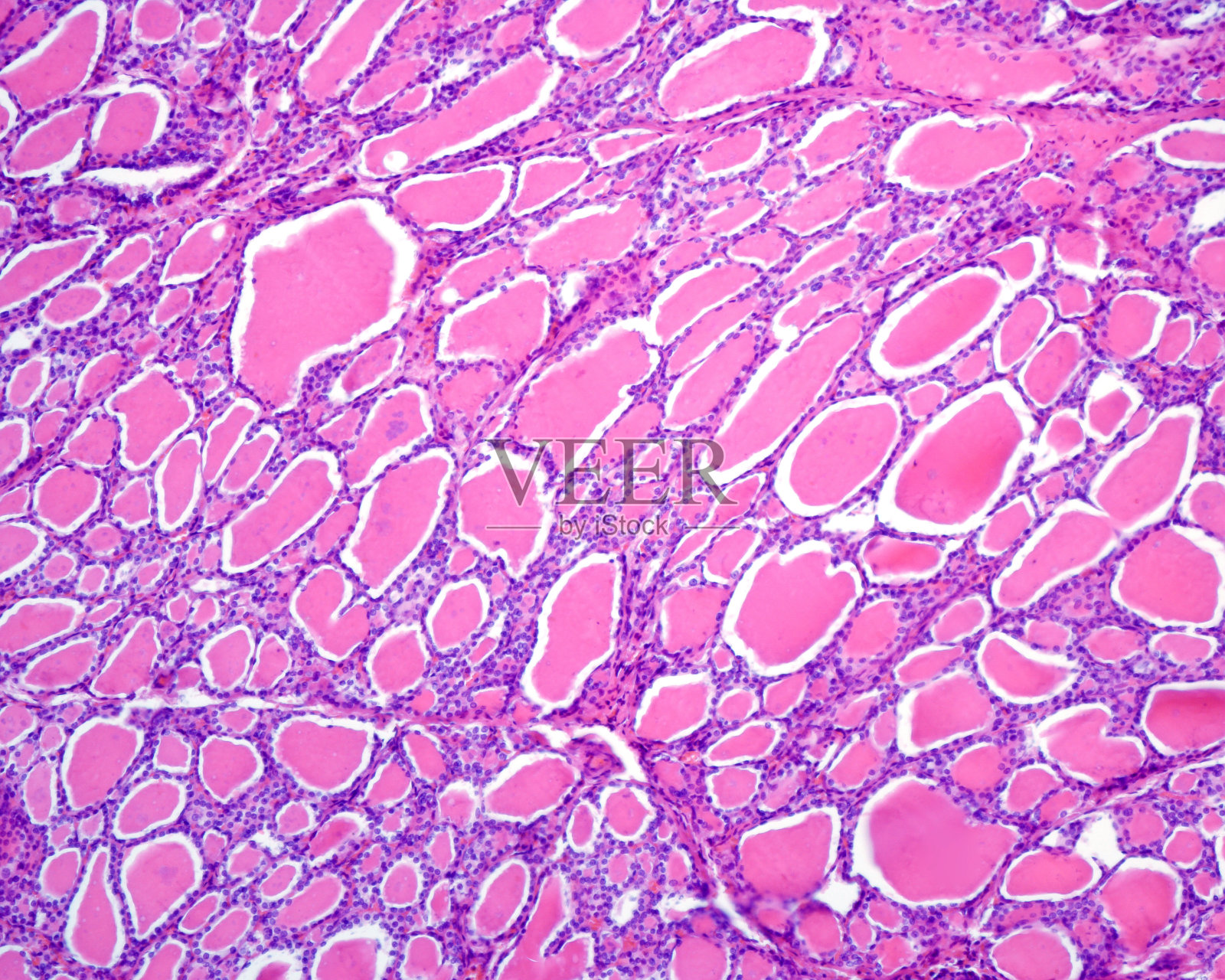 人类甲状腺。滤泡腺瘤照片摄影图片